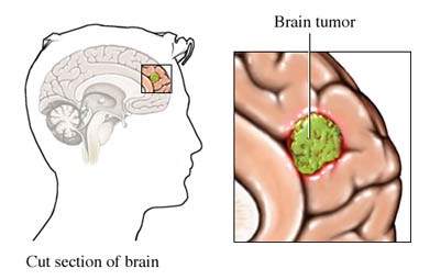 a benign brain tumor won't spread, but it can still put pressure on the brain